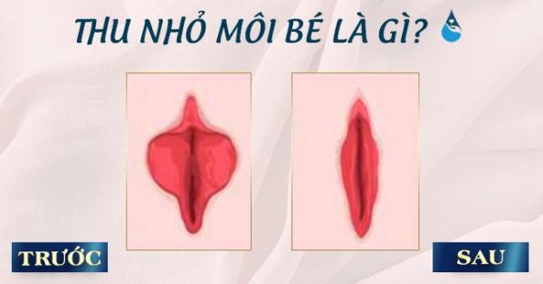 [Chị em nên tham khảo] 10+ Thông tin về thu nhỏ môi bé