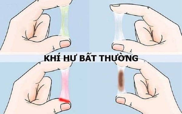 Huyết trắng ra nhiều là bị gì – Giải đáp từ BS CKII Vũ Thị Thanh Dung