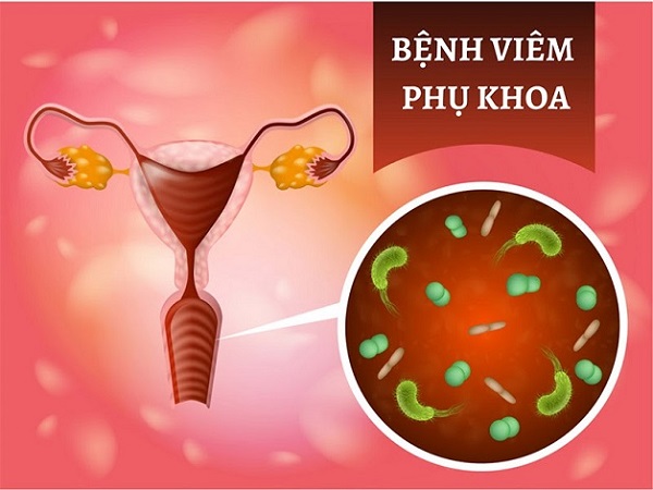 [Chị em nên biết]: Các bệnh viêm nhiễm phụ khoa thường gặp