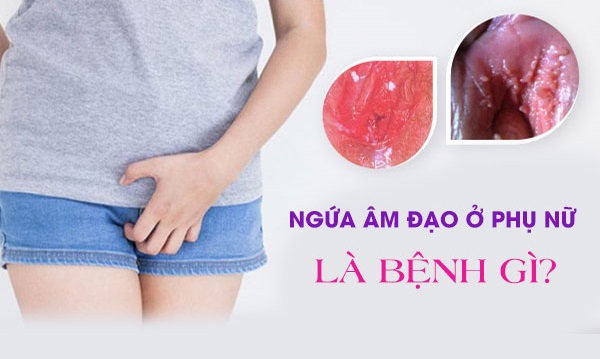 [Bác sĩ giải đáp]: Ngứa âm đạo là bị gì?