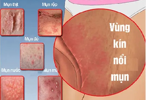 [Tổng hợp] Hình ảnh nổi mụn ở vùng kín nữ thường gặp