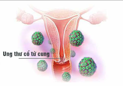 Ung thư cổ tử cung giai đoạn 1: Nguyên nhân, triệu chứng, nguy hại