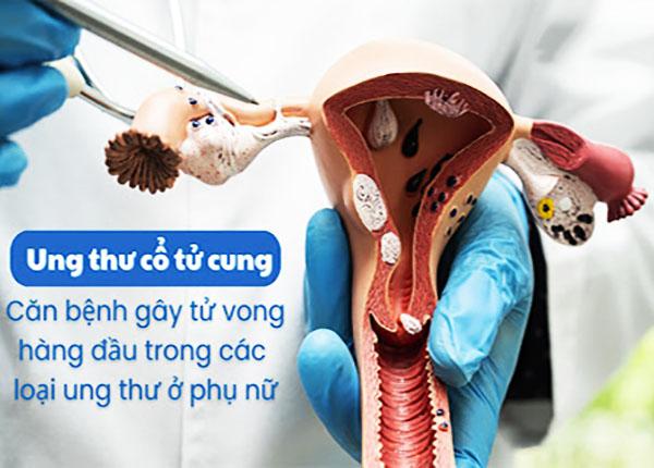 Dấu hiệu ung thư cổ tử cung giai đoạn 2 không thể xem nhẹ!